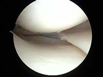 torn meniscus