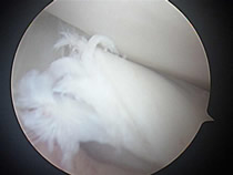 torn meniscus