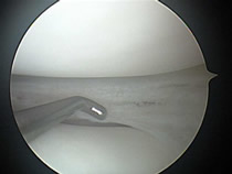 torn meniscus