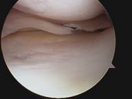 torn meniscus