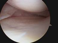 torn meniscus